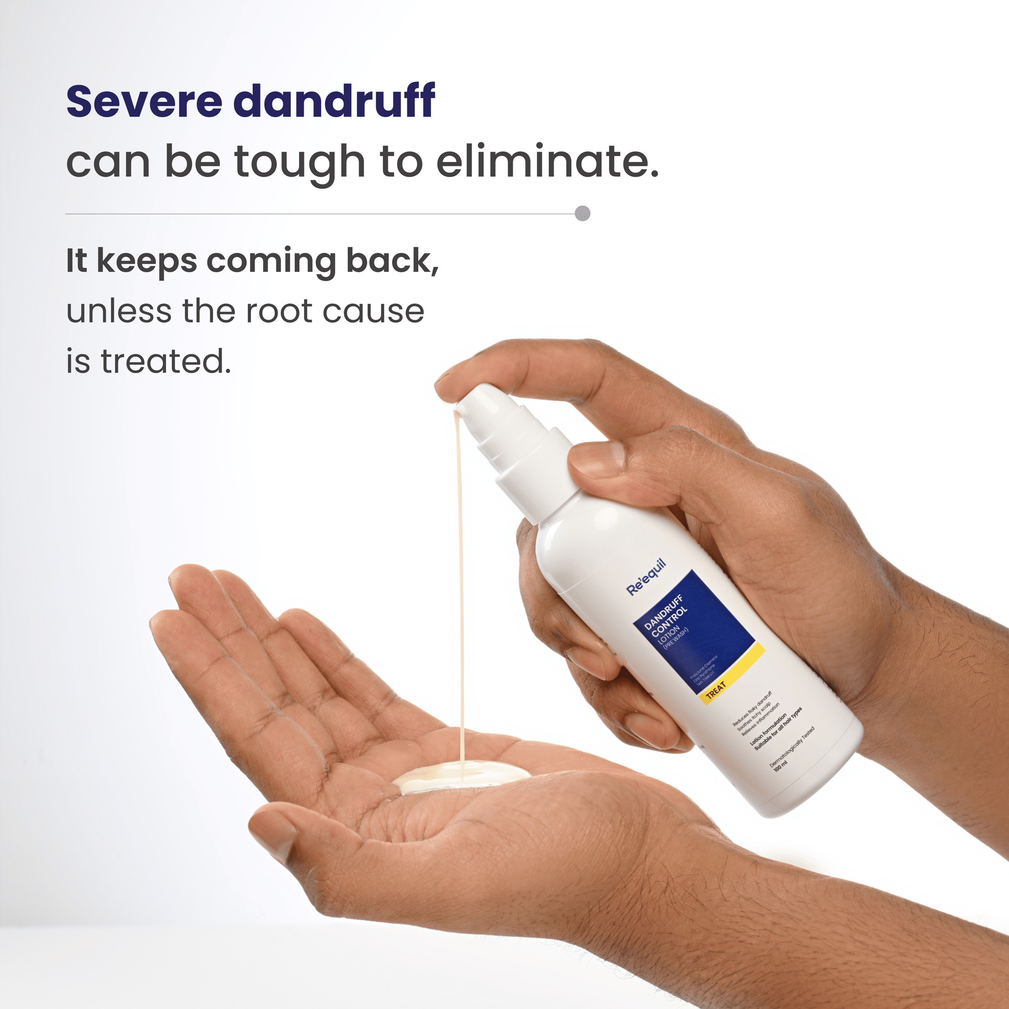 Dandruff Control Lotion-100ml